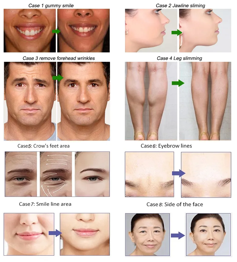 Slimming Anti Wrinkle Beutox Batulaxs Resty Dermal Filler Juvederms 1